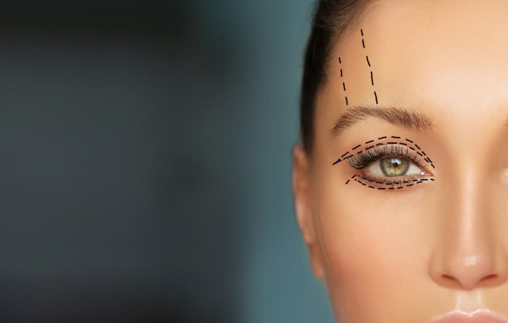 Lower and upper Blepharoplasty