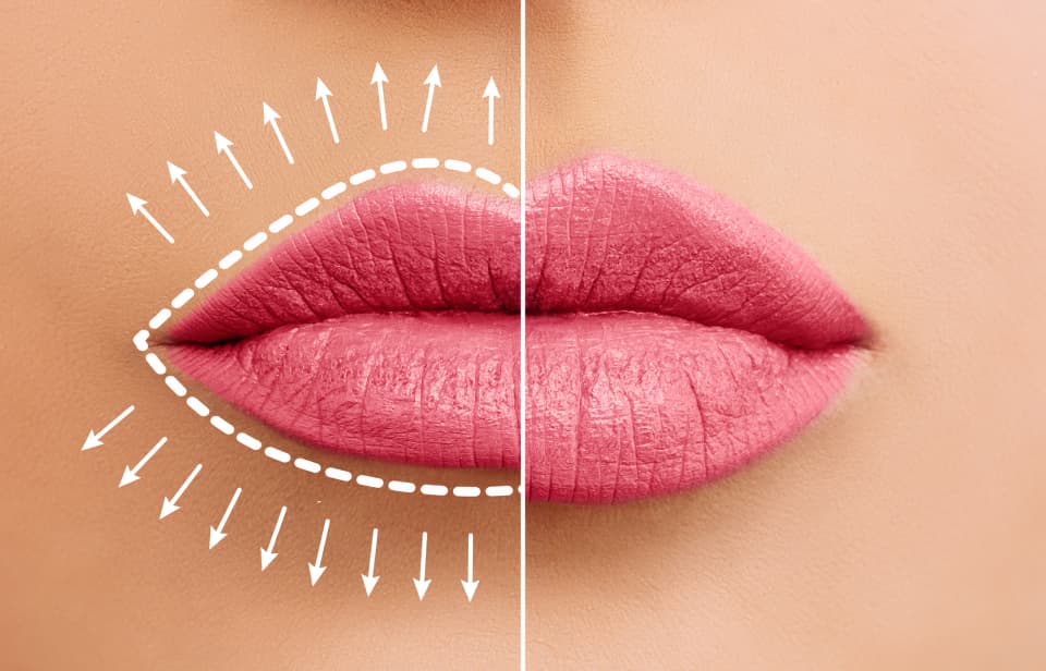 Lip Fillers, The Lips You Want