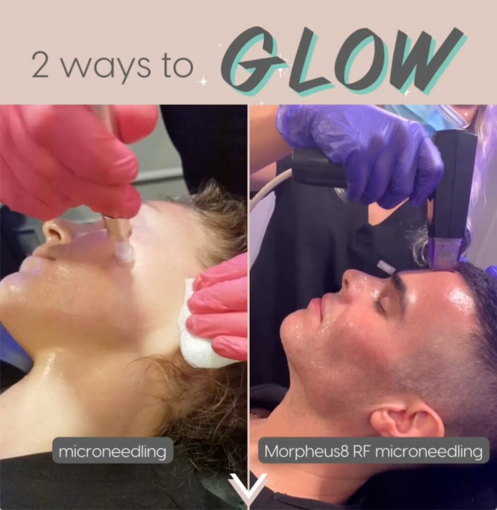 two clients receiving procedure at Evolve Medspa, the one on the left is getting microneedling and the one on the right is getting Morpheus8