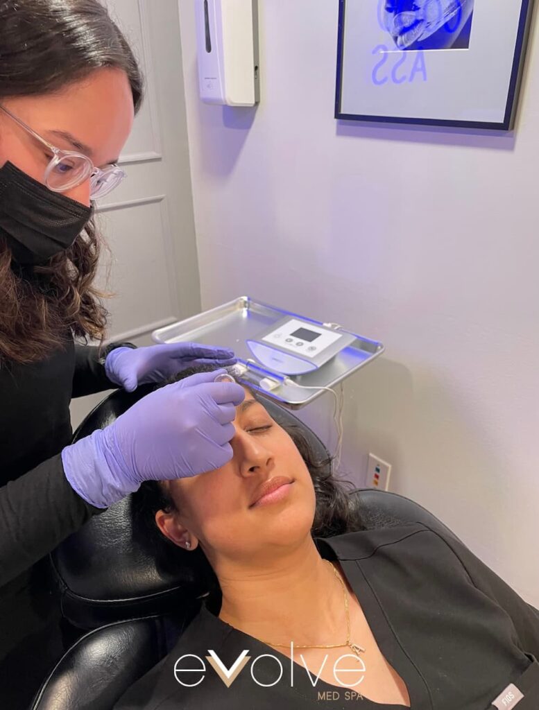A women experiencing microneedling in the area between her eyebrows at an Evolve Medspa facility.