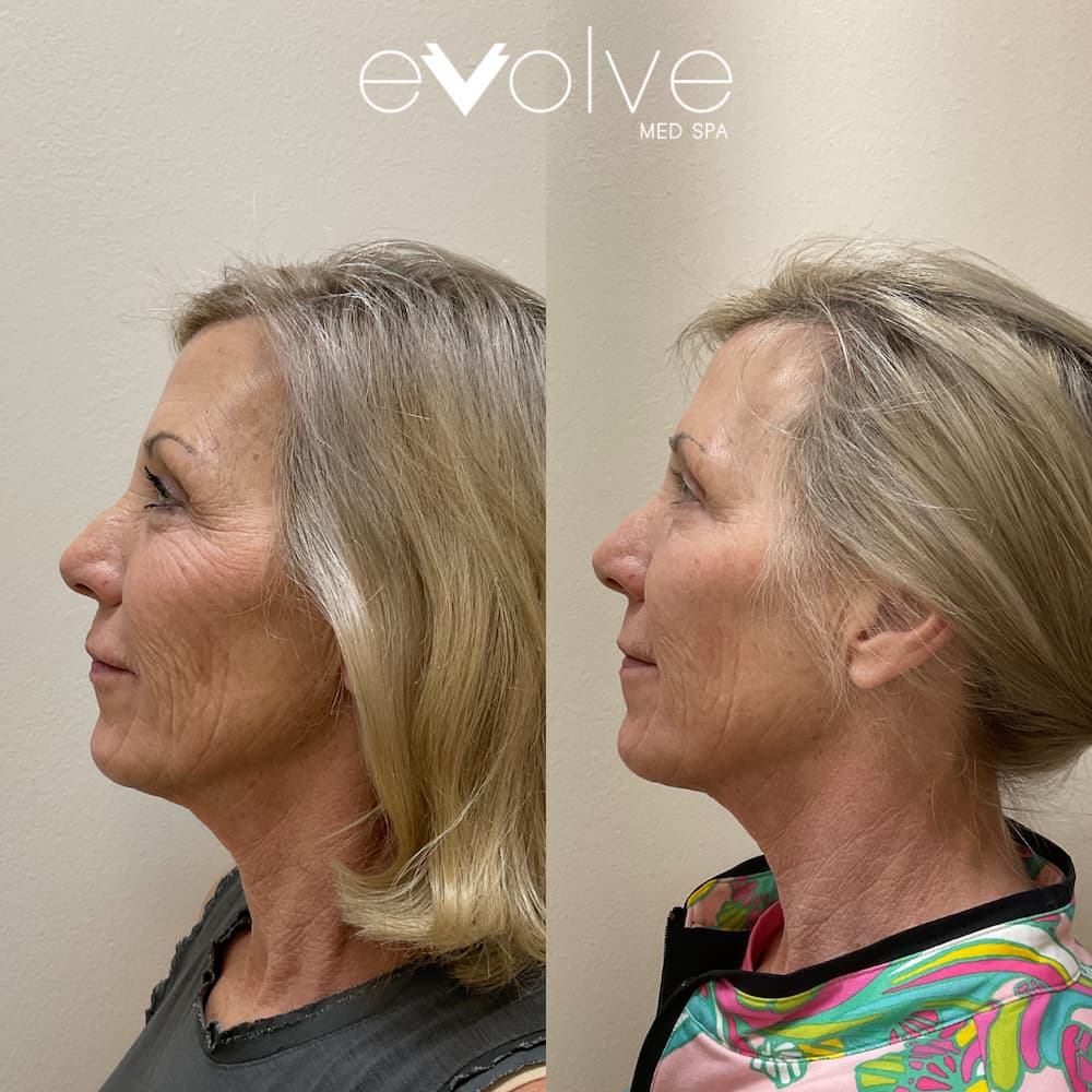 A before and after comparison of an older blonde woman, displaying the results of her microneedling treatment. 