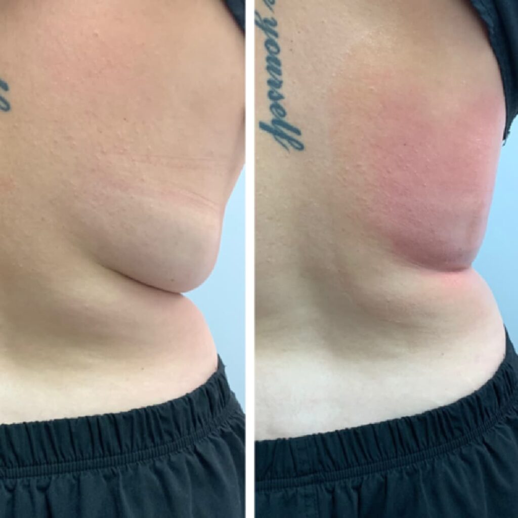 Client says goodbye to love handles after cryoskin treatment in Bel Air MD
