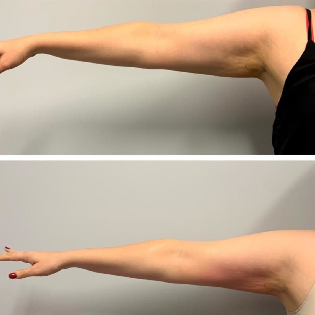 Toned arms after cryoskin treatment at Frederick MD MedSpa