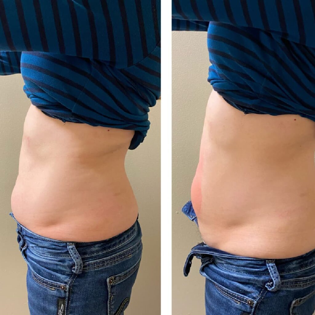 Belly fat reduction after cryoslimming treatment in Frederick MD