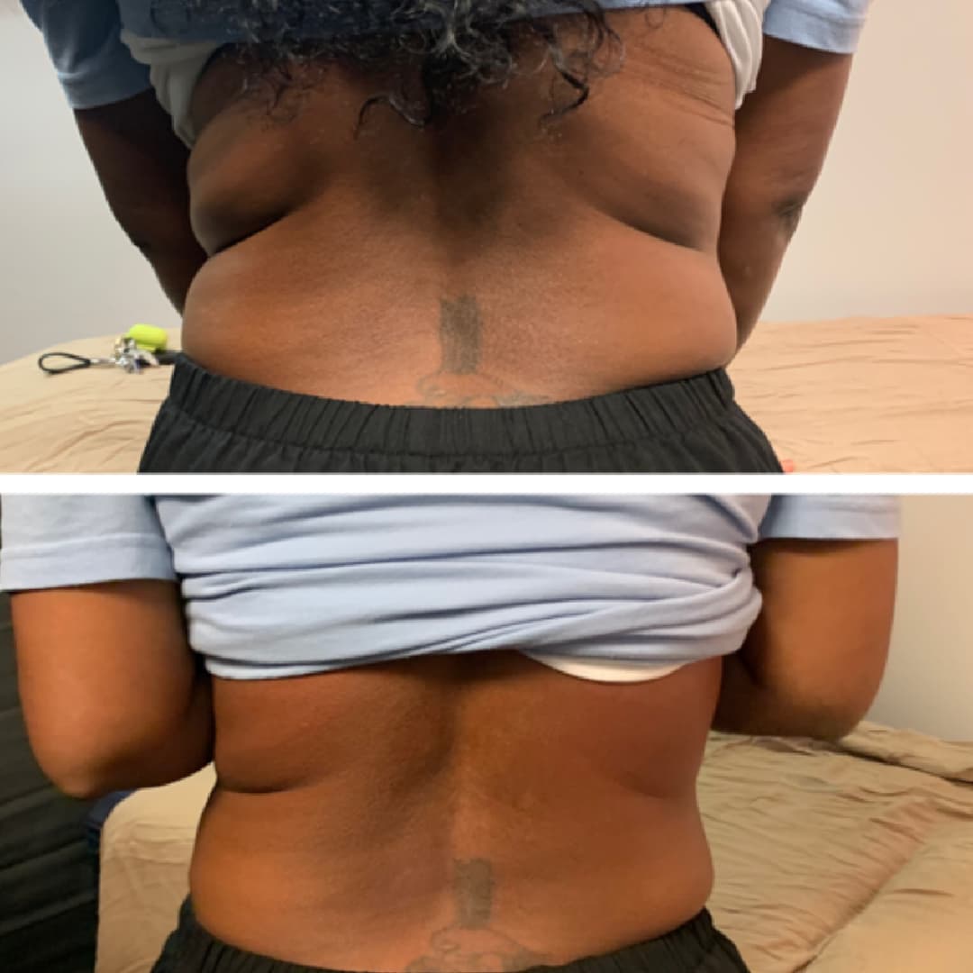 Love handles disappear after cryoskin sessions at MD MedSpa