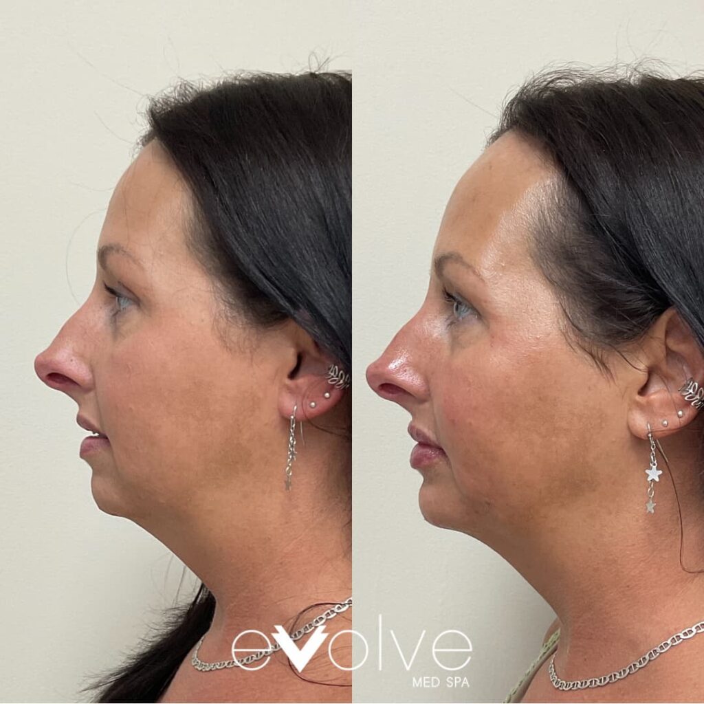 Dermal fillers to Cheek Chin Prejawls and lips in Frederick MD
