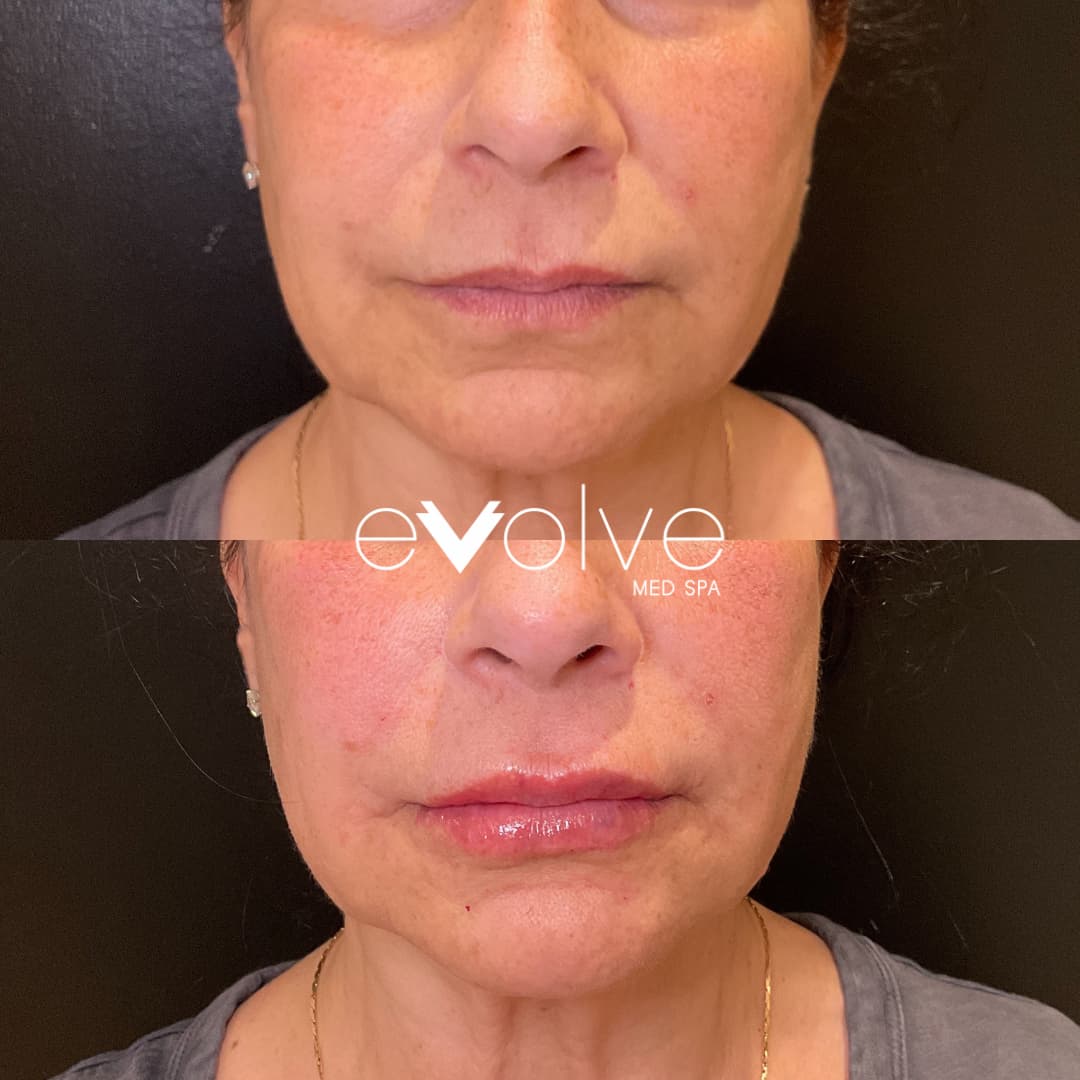 Restylane Filler to Lips and NLFs in Ridgewood NJ