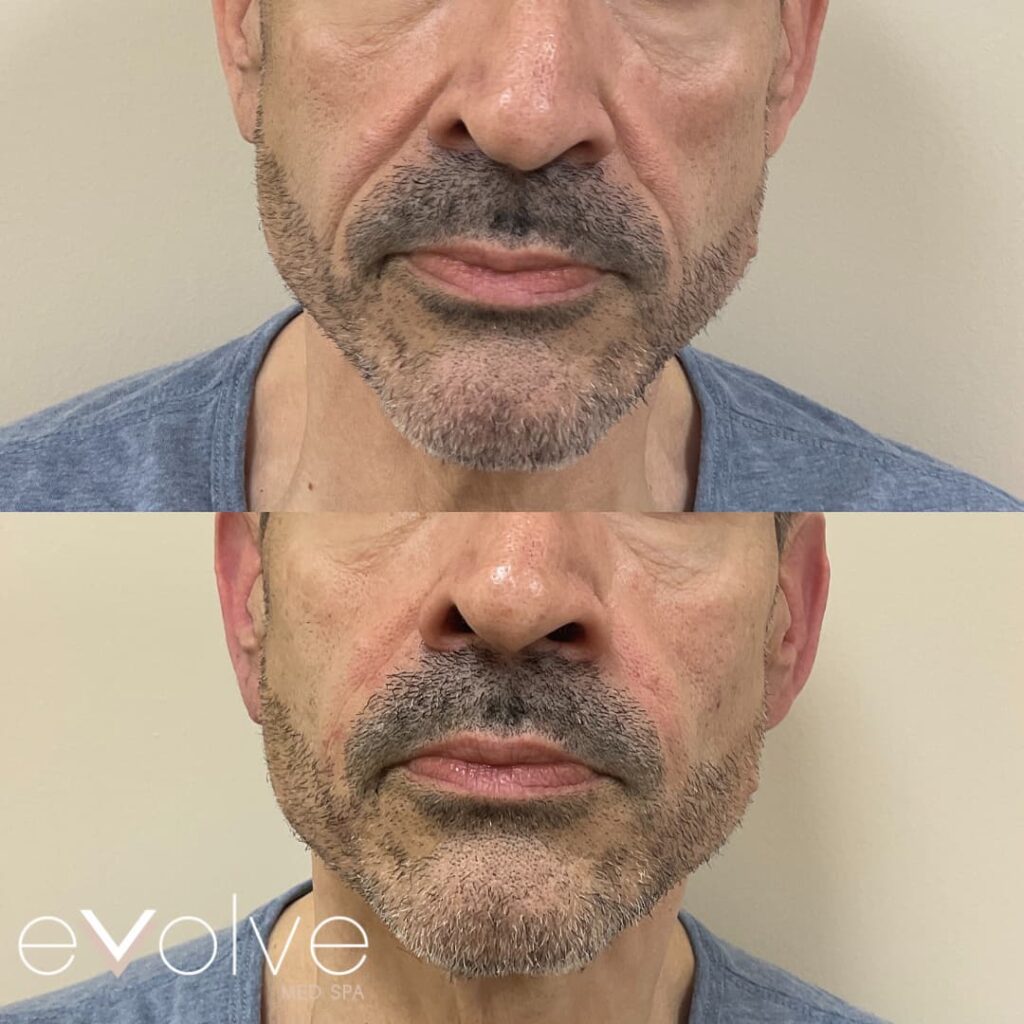 Facial filler on male client in Bel Air MD