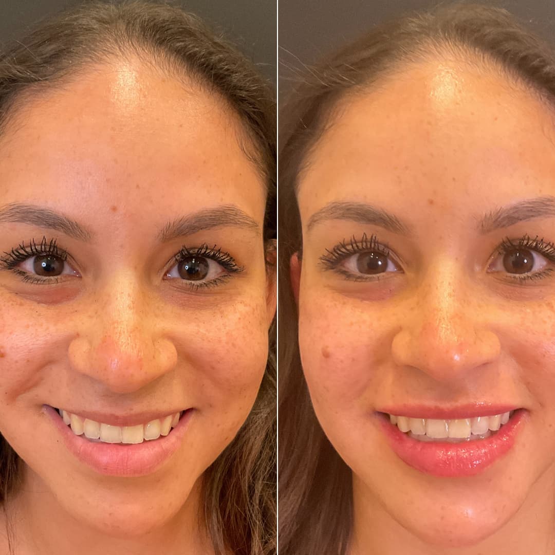 After Red Bank med spa uses dermal fillers to improve clients facial profile