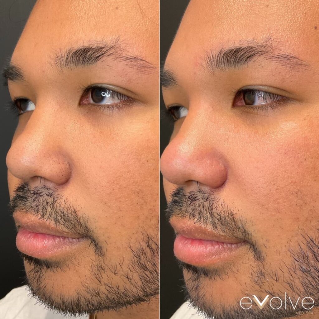 Glowing male skin using DiamondGlow facial at NJ MedSpa