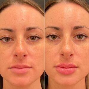 lips after Juvederm injection in Red Bank NJ