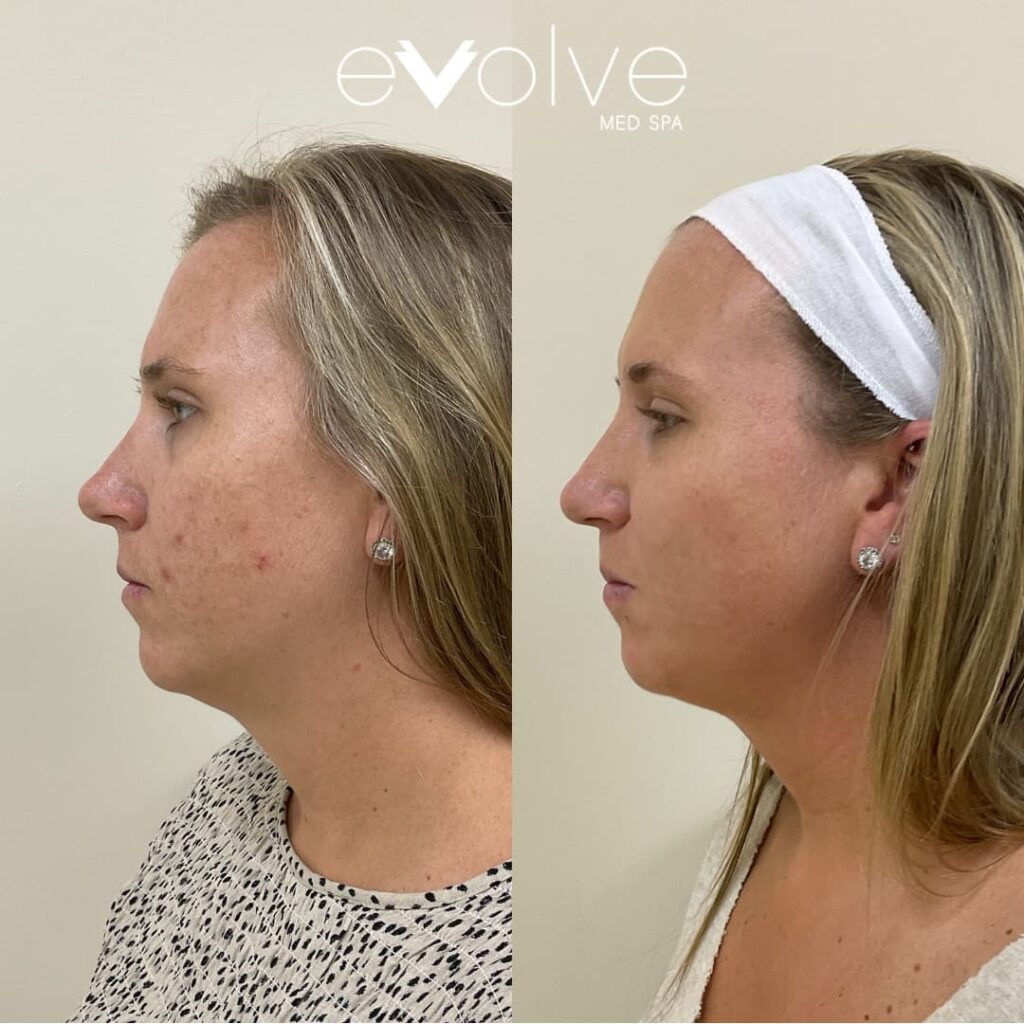 Improved skin texture using microneedling in Bel Air MD