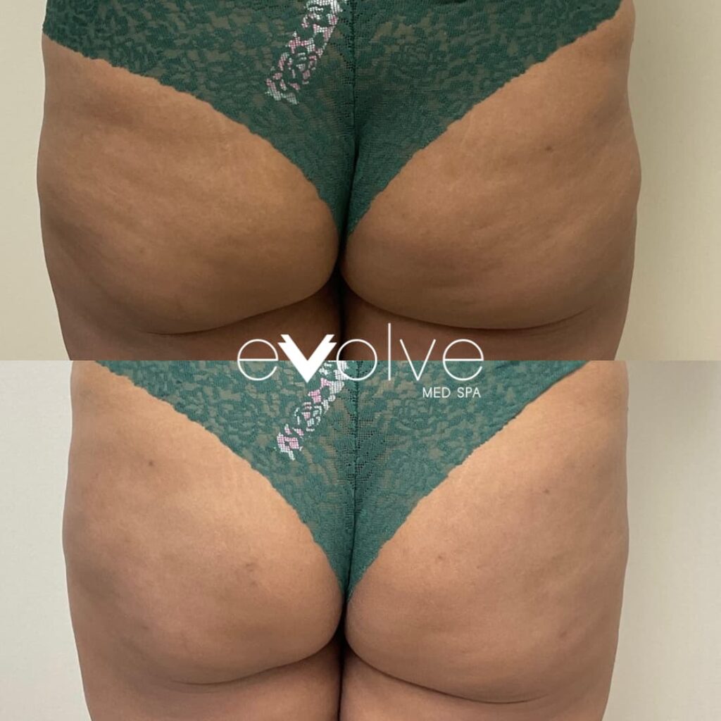 Cellulite reduction using Radiesse BBL treatments at Frederick MD MedSpa