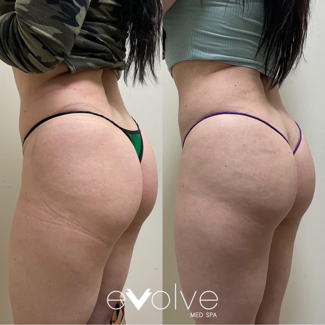 Butt lifted after BBL treatment in Bel Air MD