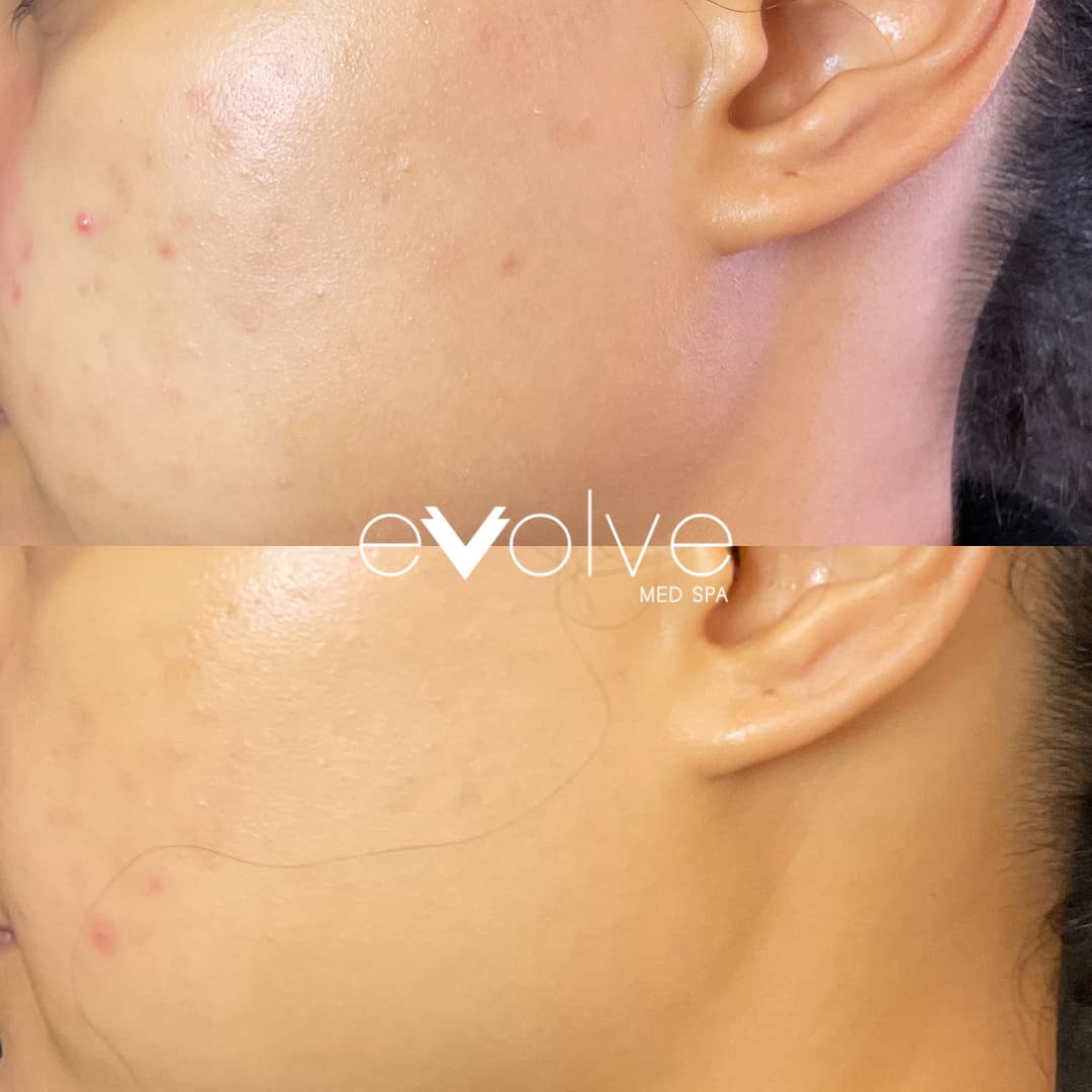 Reduced Acne on cheek after PRP treatment in Hoboken