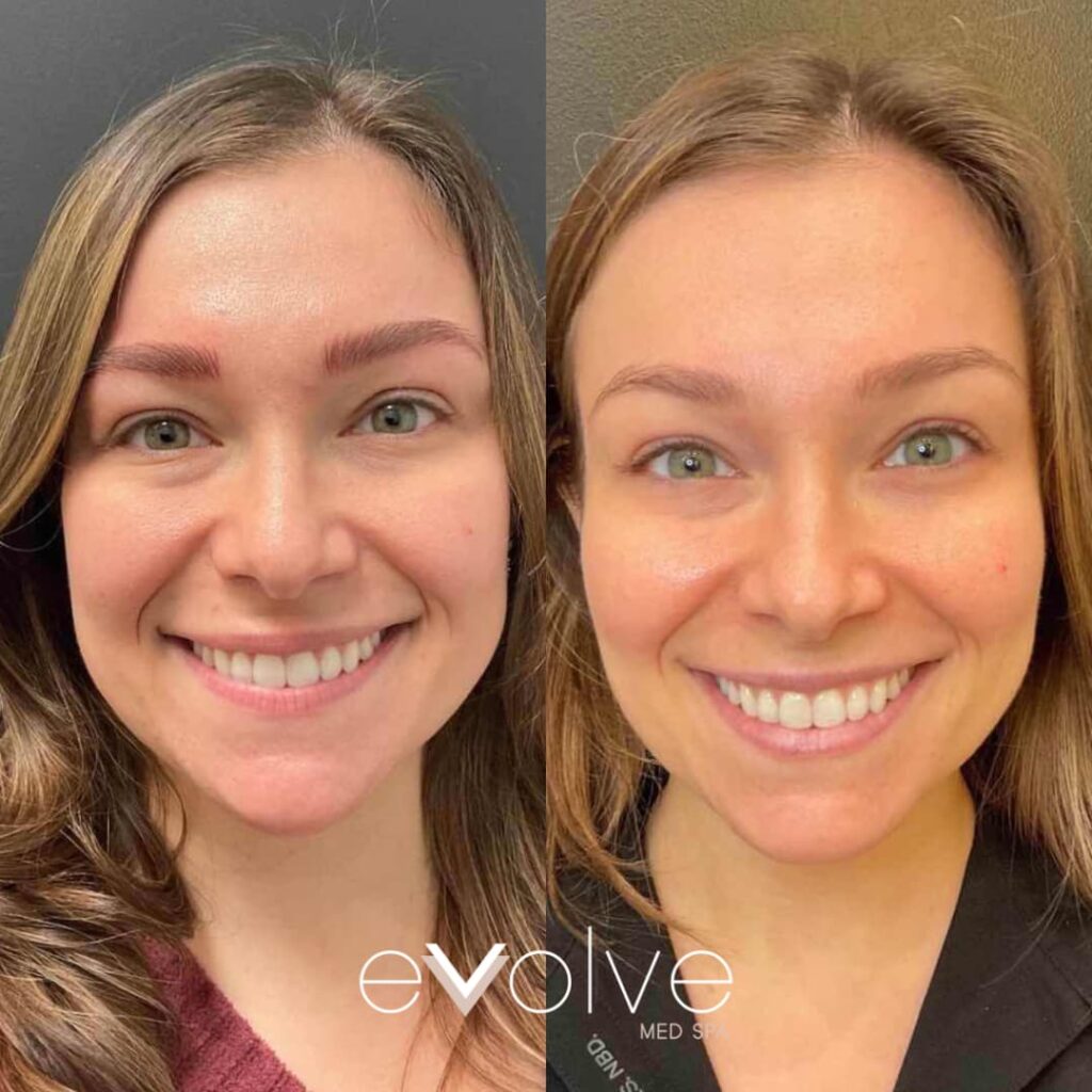 Glowing skin after Microneedling and PRP treatment in Hoboken NJ
