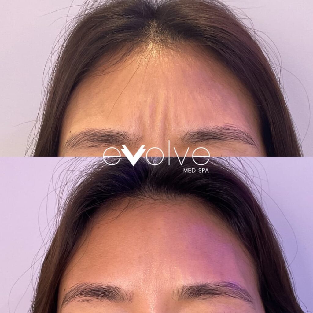 Reduction in lines while squinting using botox injection in Tribeca