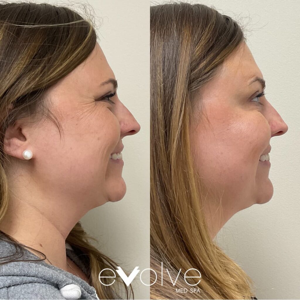 Smile lines reduced using dysport in Bel Air MD