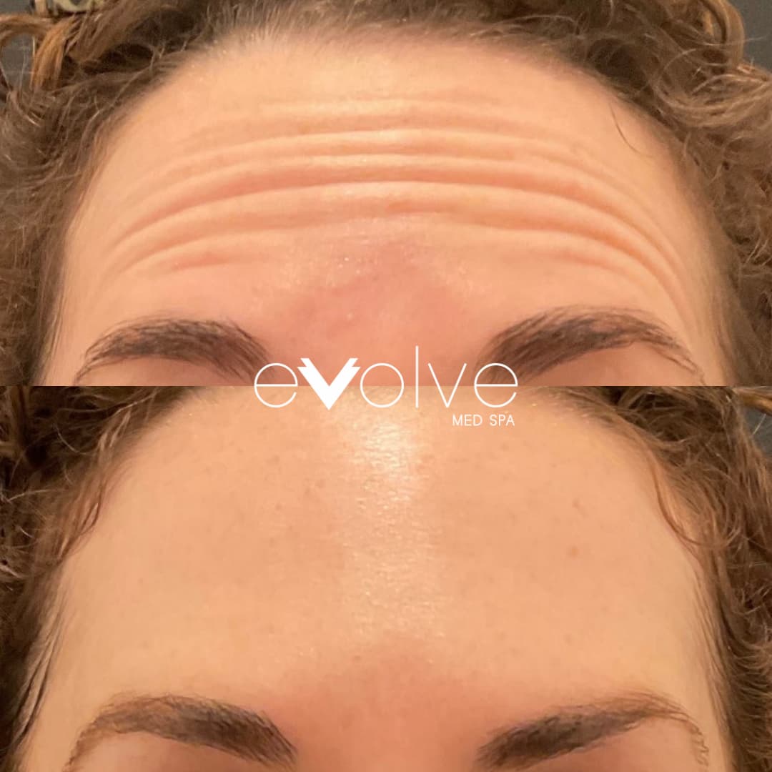 Dysport used to make forehead lines disappear in Hoboken MedSpa