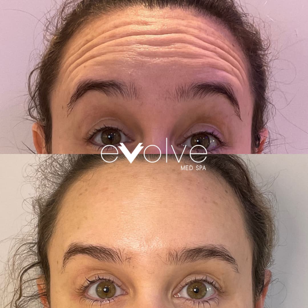 Client received jeauveau to erase forehead lines in Ridgewood NJ