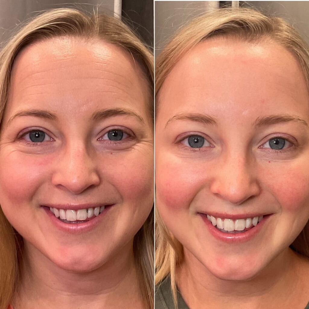 After Botox treatment at Hoboken NJ med spa to reduce fine lines while smiling