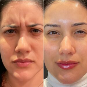 11's disappear after botox injection to Glabella region at Montclair med spa