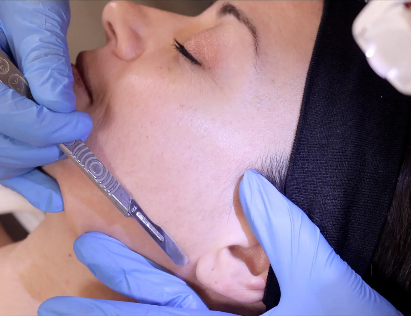 Close-up of a dermaplaning treatment being performed by a specialist using a precision tool for exfoliation and skin rejuvenation.