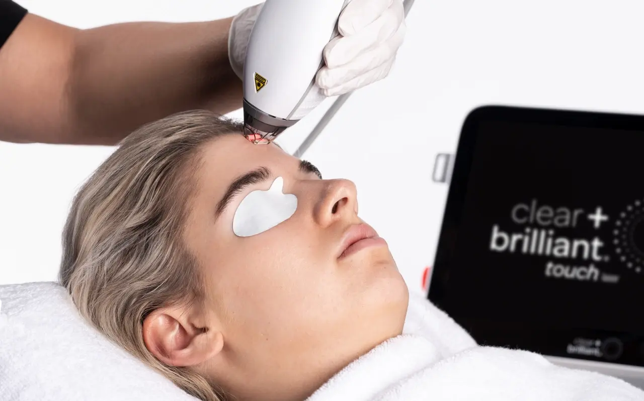 A person receiving a Clear + Brilliant laser treatment, lying down with protective eye shields, while a professional uses a laser device on their forehead in a clinical setting.