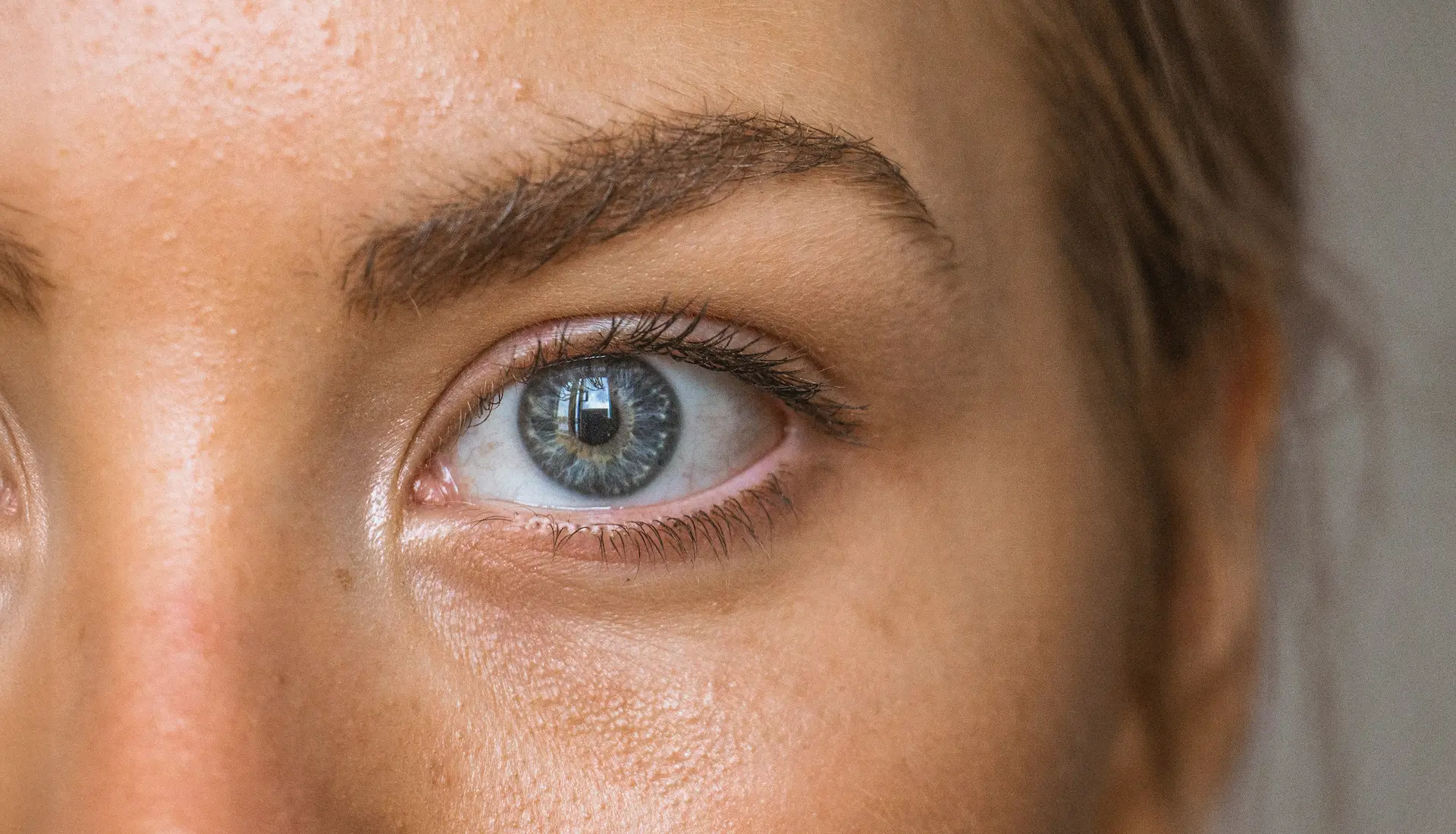 What causes Dark under eyes and how to treat? 