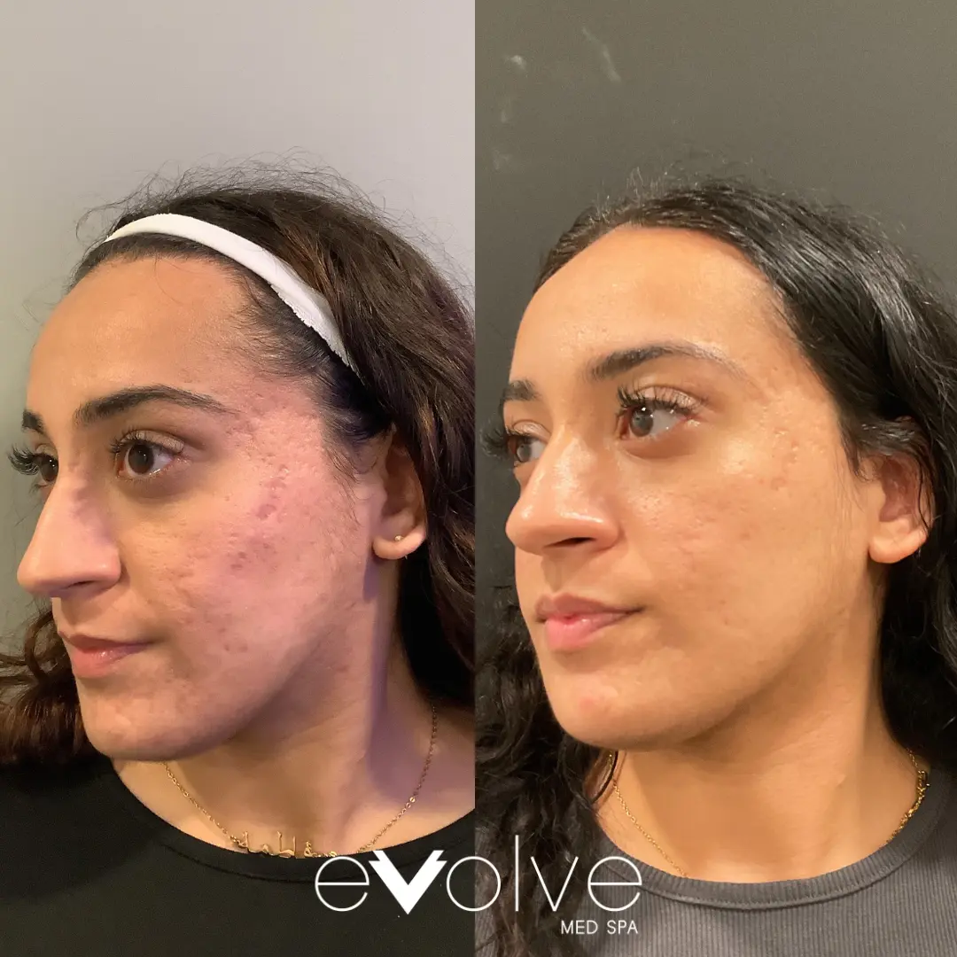 Skin Transformation Microneedling + PRP for Acne Scarring