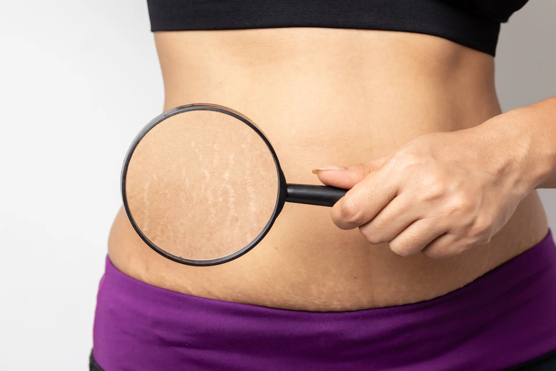 Stretch Marks: Causes and Effective Treatment Options