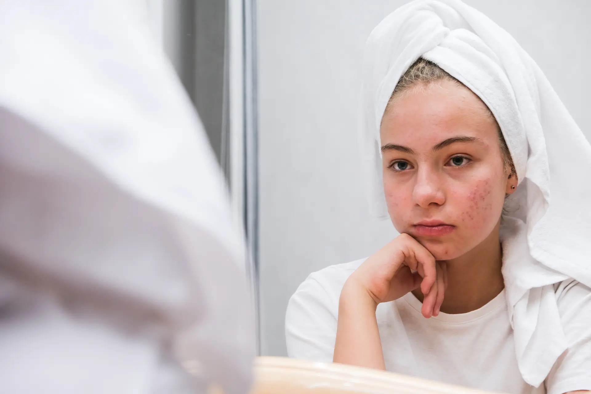 Conquer Acne: Causes and Effective Treatment Strategies 