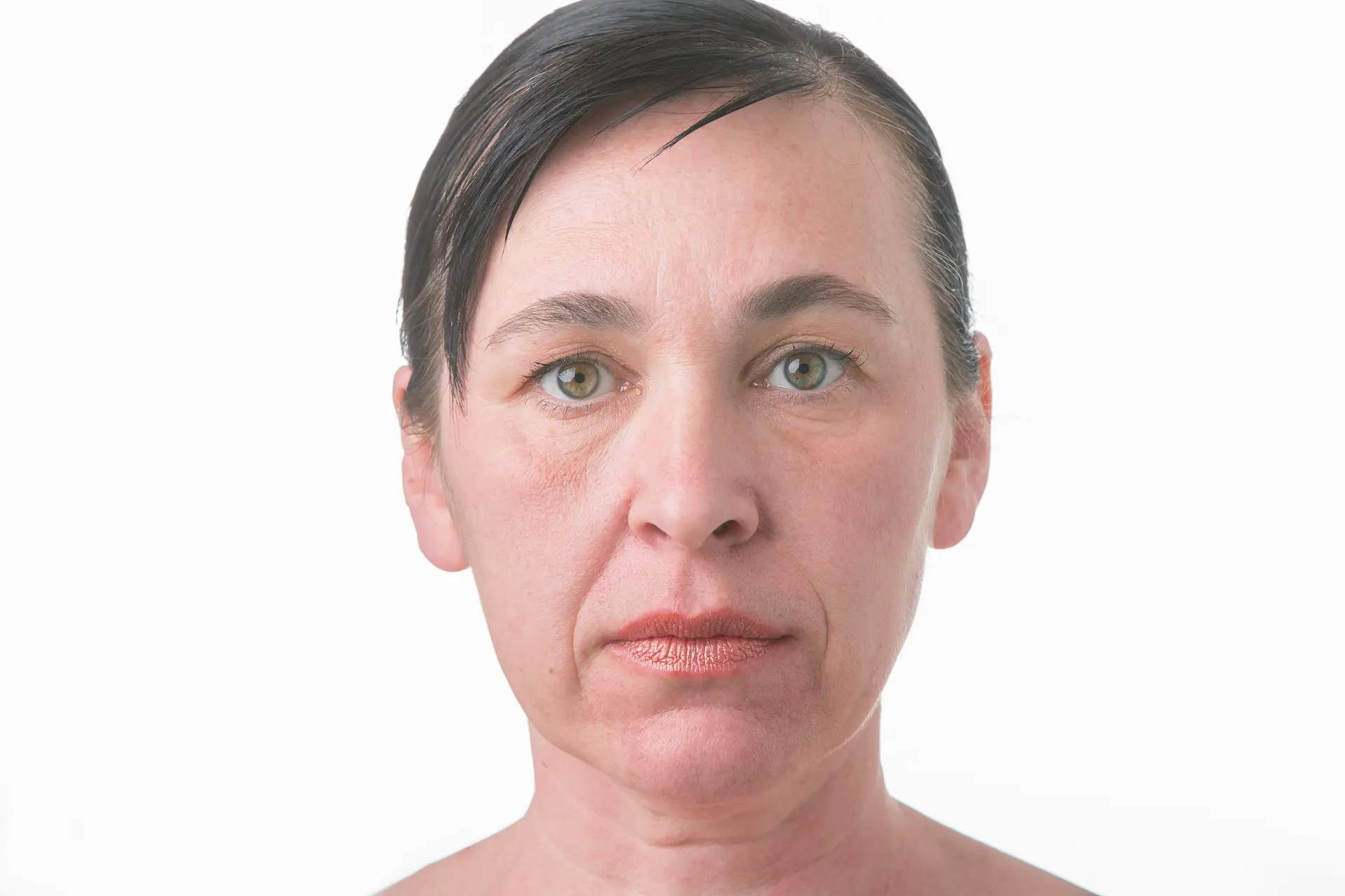 Nasolabial Folds: Causes and Effective Treatment Options 