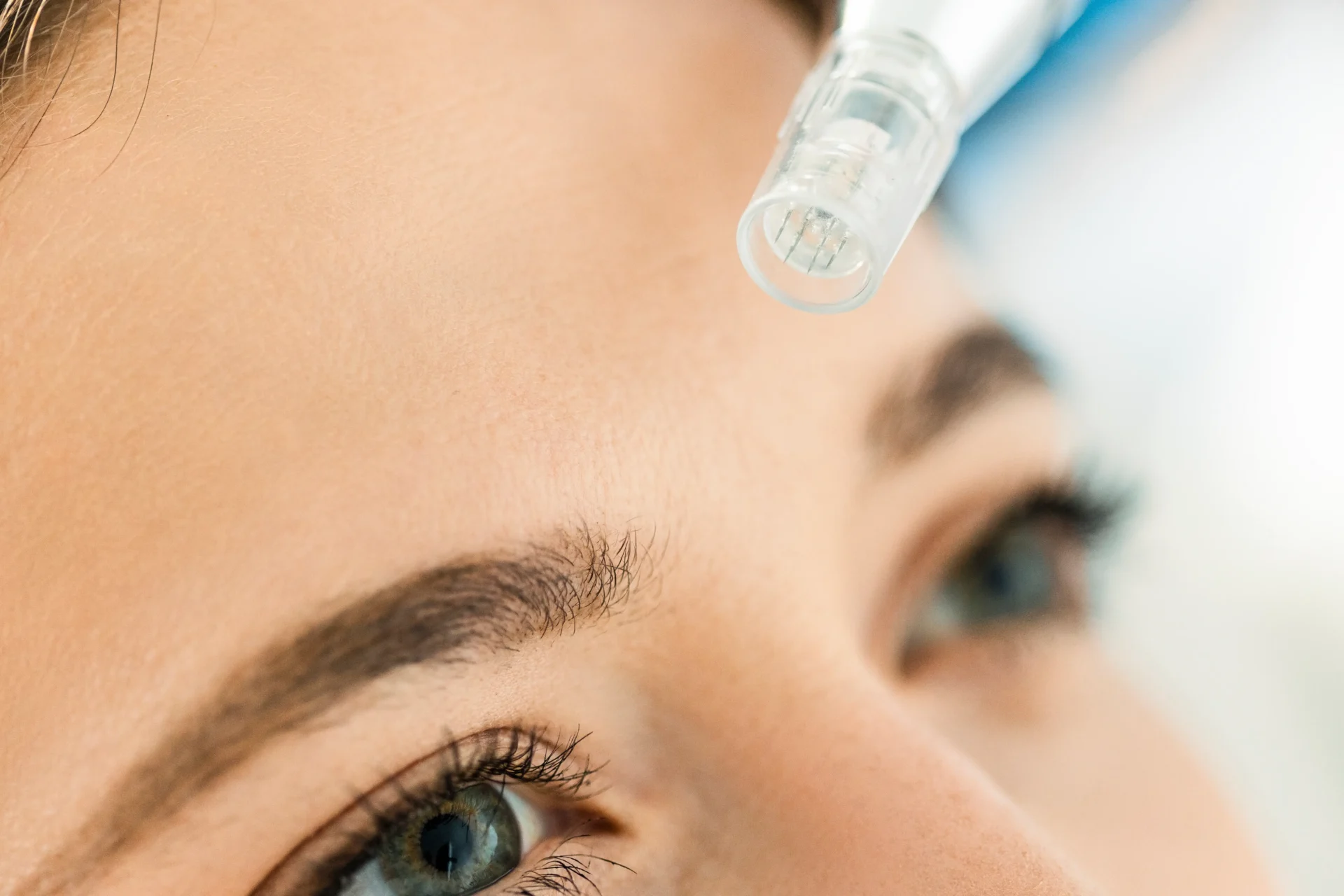 Skinpen microneedling treatment to women's forehead