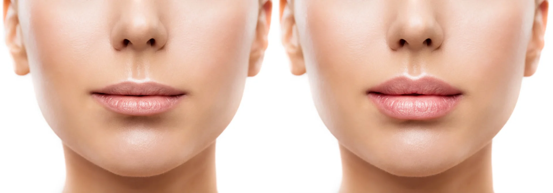 lips adjustment using hylenex