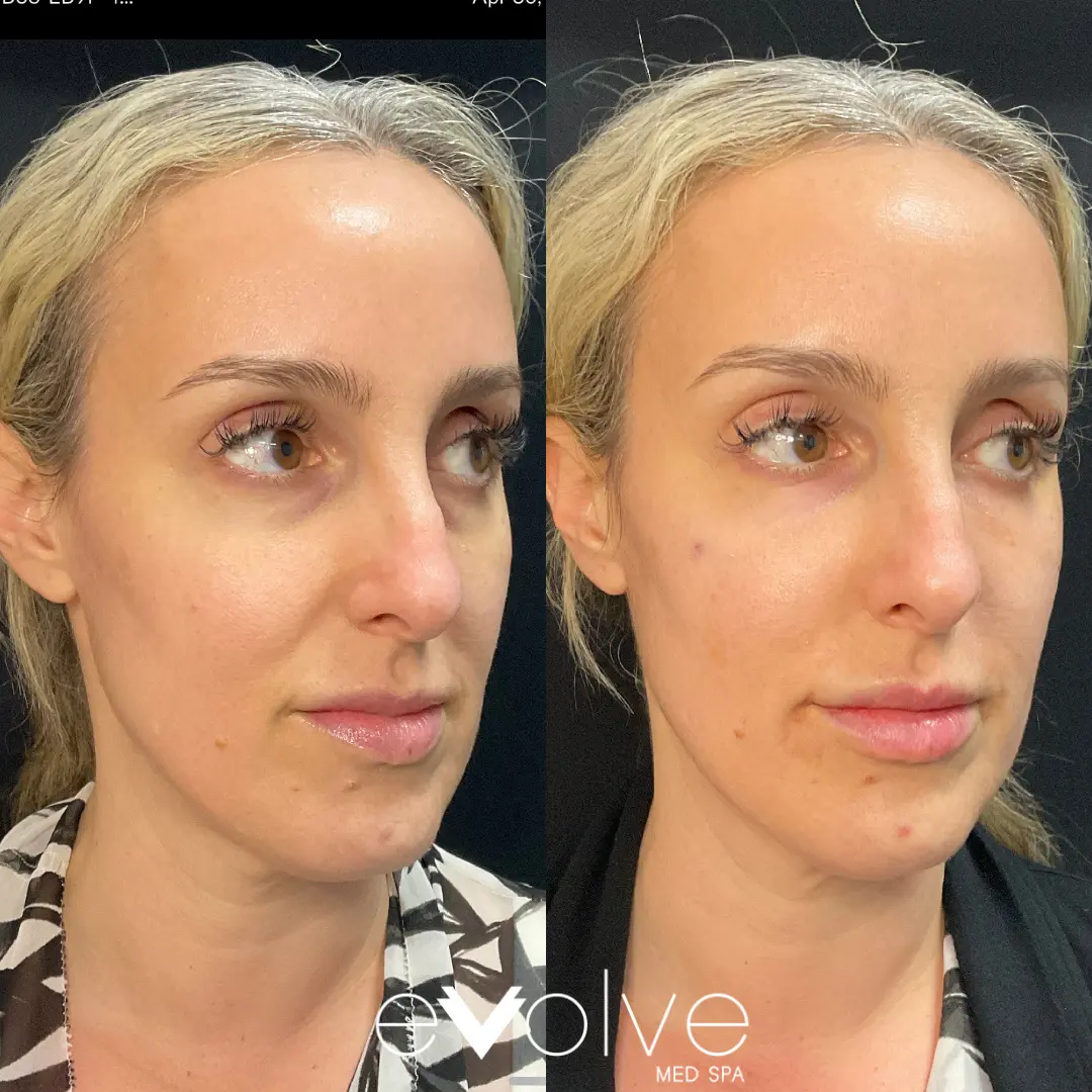 prf gel injection before and after for facial volume in nlf