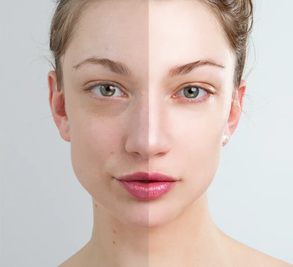 prf injection for facial volume