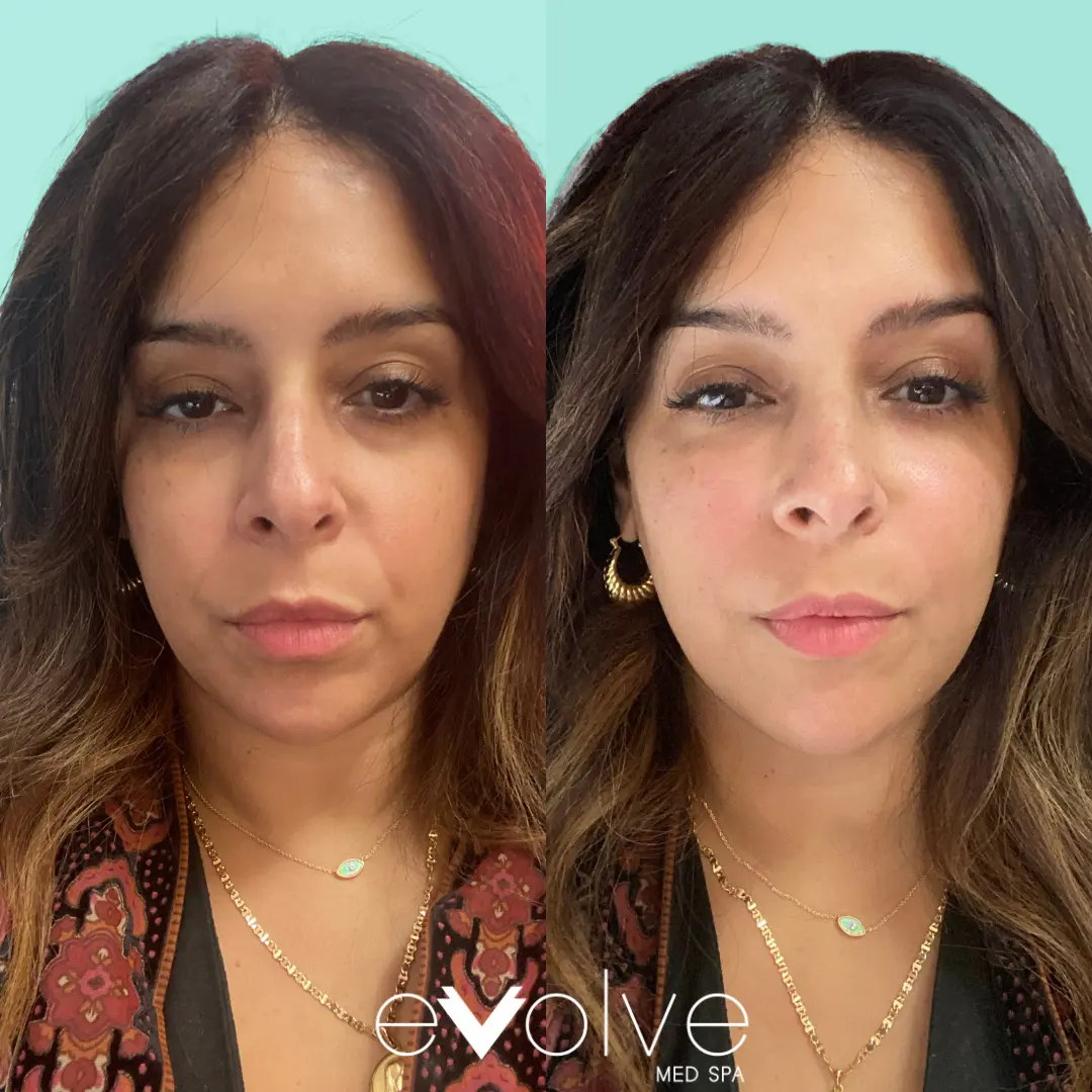 prf treatment before and after for under eyes