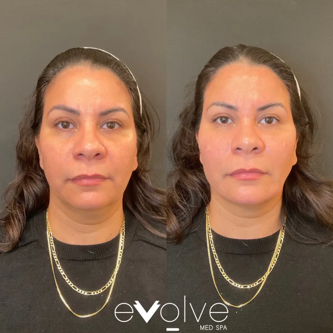 Belotero Filler Before and After to Cheeks and under eyes