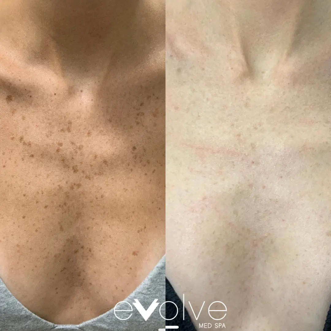 Sun Spots on chest disappear after IPL treatment