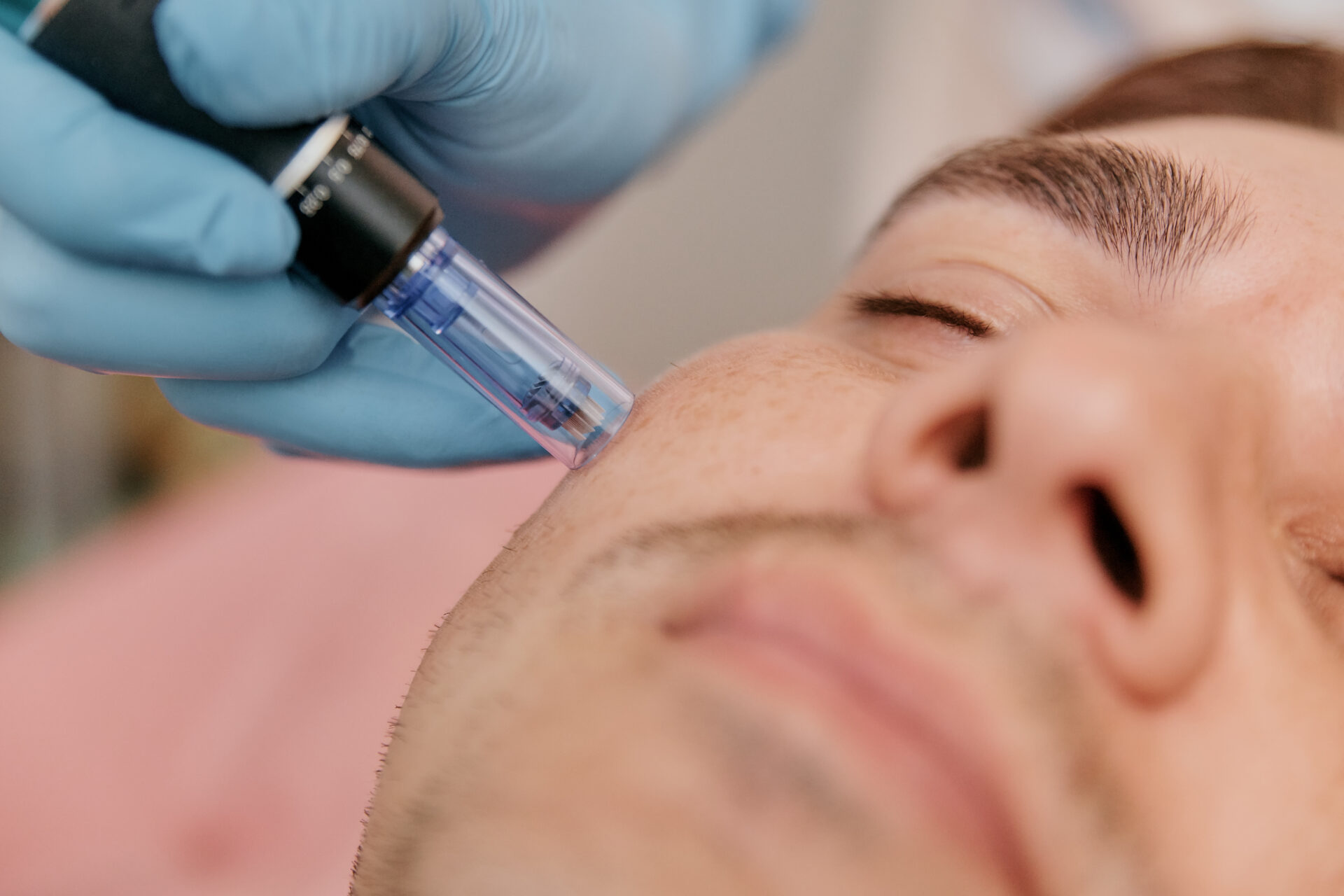Botox + Microneedling: A Match Made in Skin Heaven