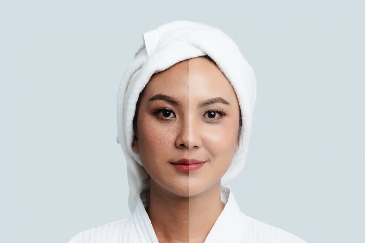 Post- Inflammatory Hyperpigmentation Before & After Microneedling