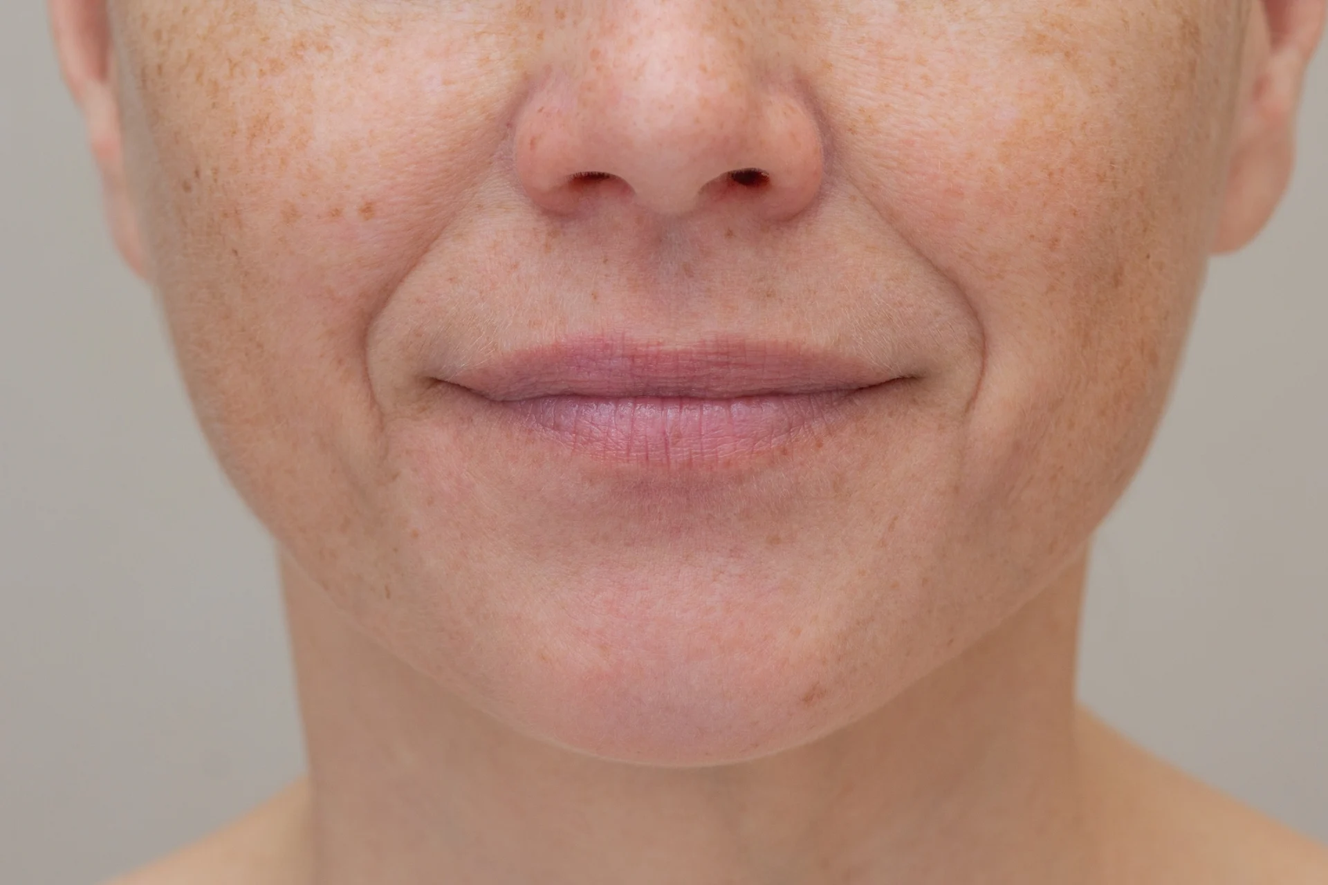 Smile Lines and Nasolabial Folds: Causes and the Best Treatment Options