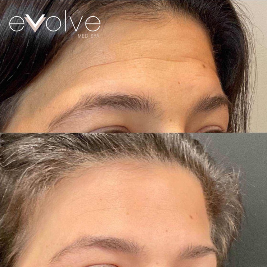 Botox before and after β Forehead + Crow's Feet, Evolve Med Spa Hoboken, NJ