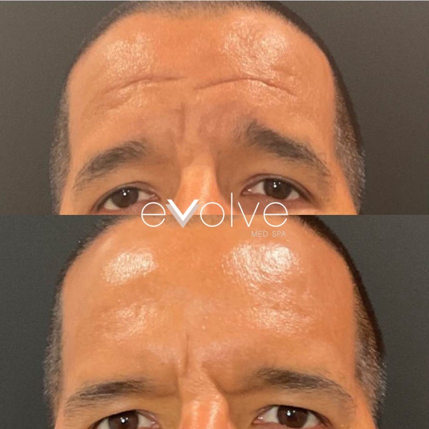 Botox before and after β Forehead Lines, Evolve Med Spa Jersey City, NJ