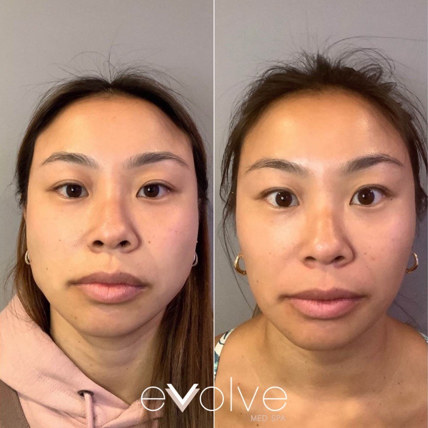 Botox before and after β Lip Flip, Evolve Med Spa Ridgewood, NJ