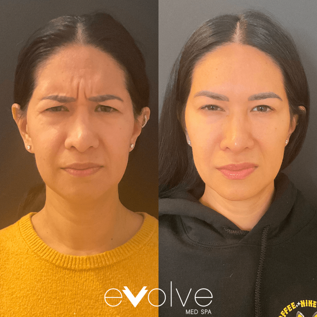 Botox before and after β Frown Lines(11's), Forehead Lines, Evolve Med Spa Denville, NJ
