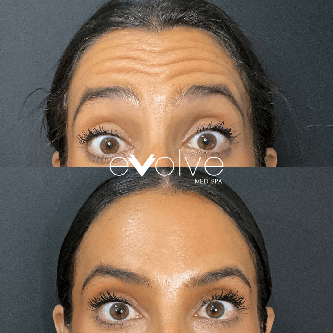 Botox before and after β Forehead Lines, Evolve Med Spa Hoboken, NJ