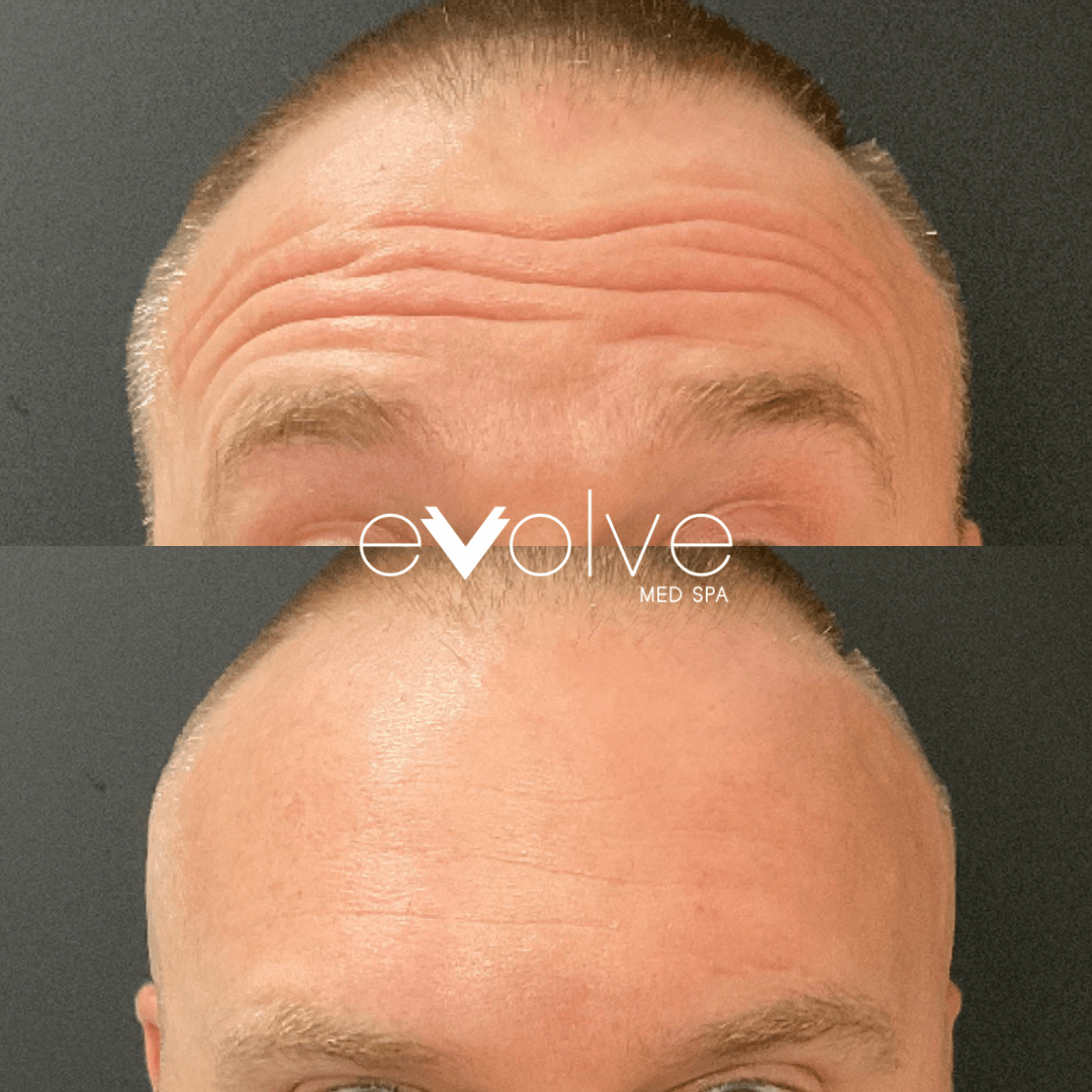 Botox before and after β Forehead Lines, Evolve Med Spa Hoboken, NJ
