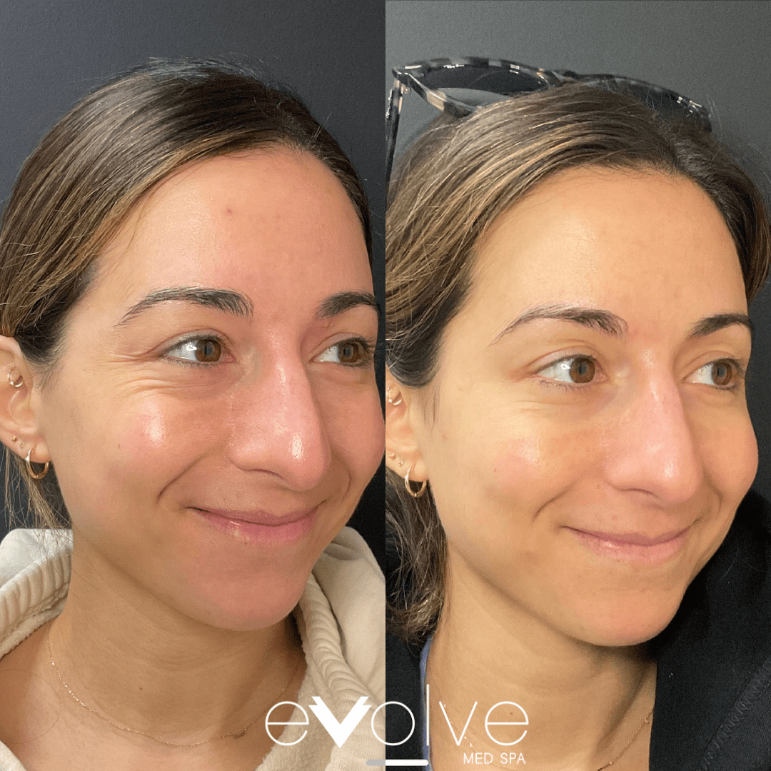 Botox before and after β Crow's Feet, Evolve Med Spa Hoboken, NJ